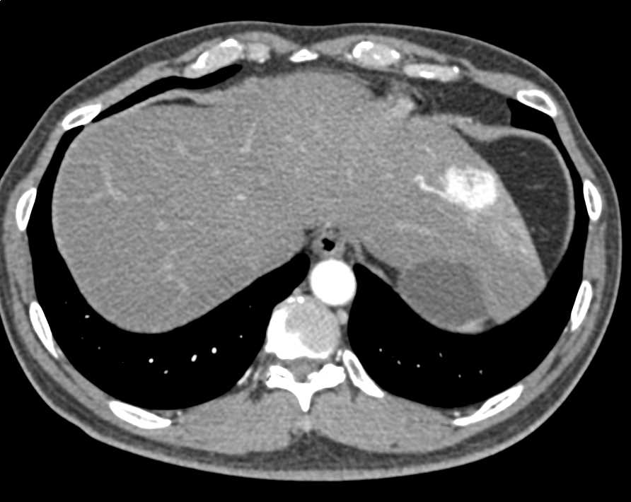 Hemangioma Left Lobe of Liver Looks Like Focal Nodular Hyperplasia (FNH) - CTisus CT Scan