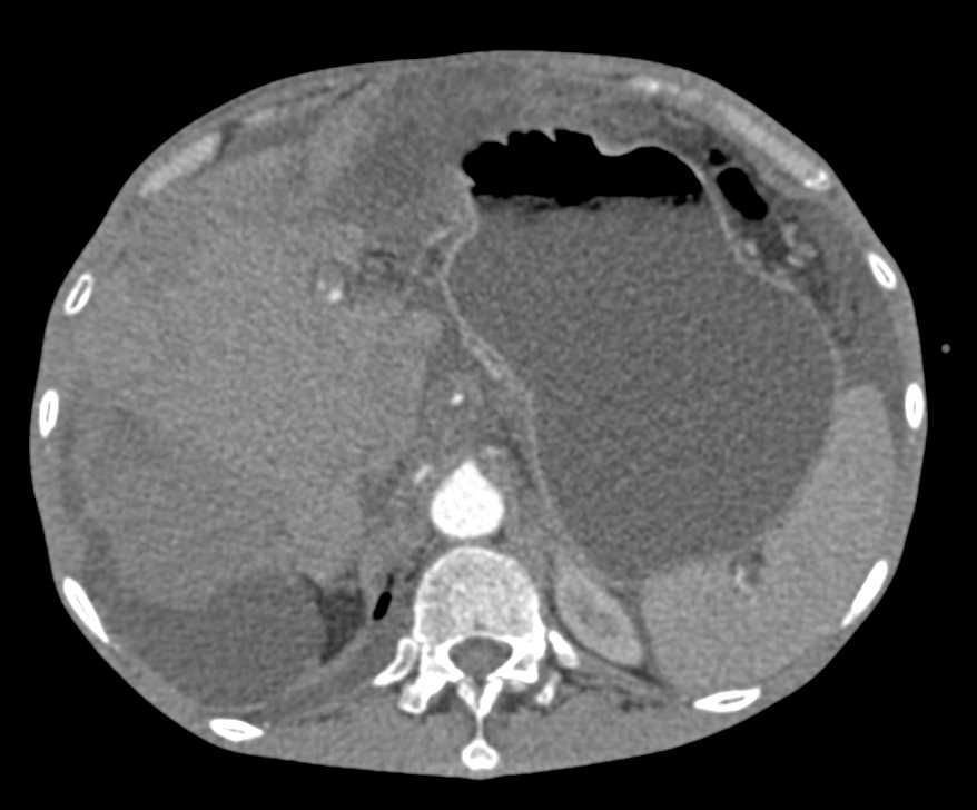 Carcinomatosis and Adrenal Metastases - CTisus CT Scan