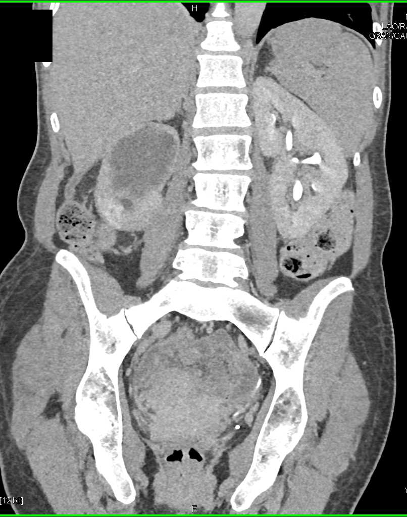 Hepatocellular Carcinoma (Hepatoma) and Obstructed Right Kidney - CTisus CT Scan