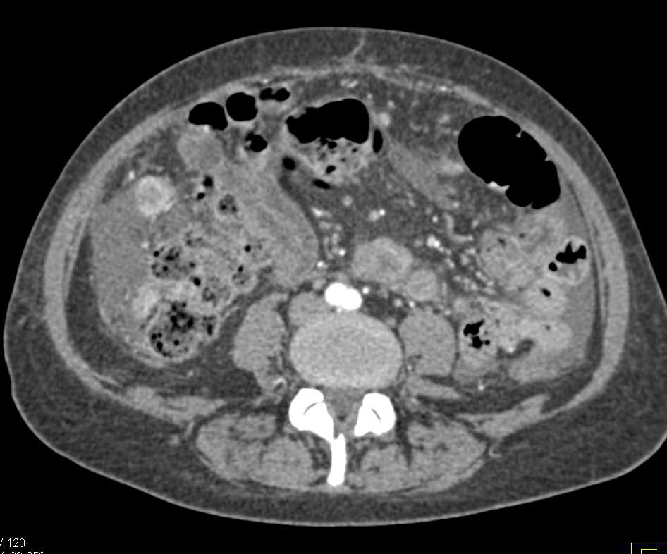 Metastatic Colon Cancer to Liver with Carcinomatosis - CTisus CT Scan