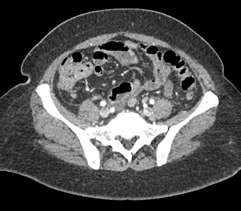 Lymphoma Involves the Liver, the Left Kidney and Adenopathy - CTisus CT Scan