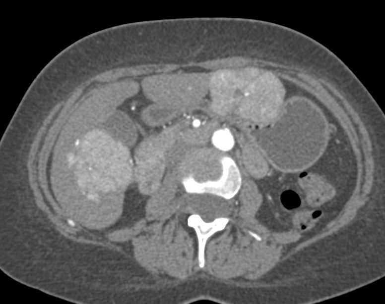 Multiple Focal Nodular Hyperplasia in the Liver (FNH) - CTisus CT Scan