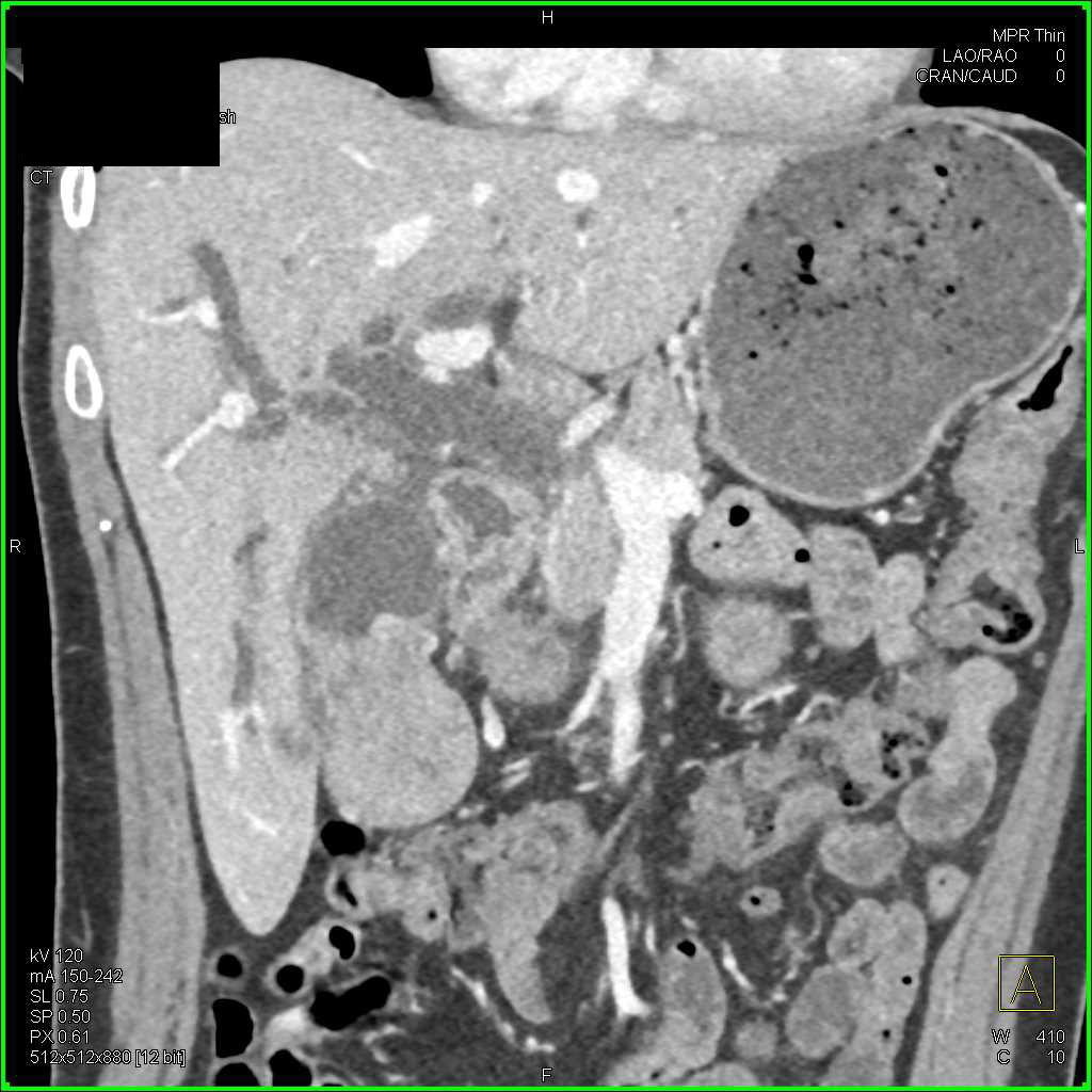 Ampullary Carcinoma with Dilated Common Bile Duct (CBD) - CTisus CT Scan
