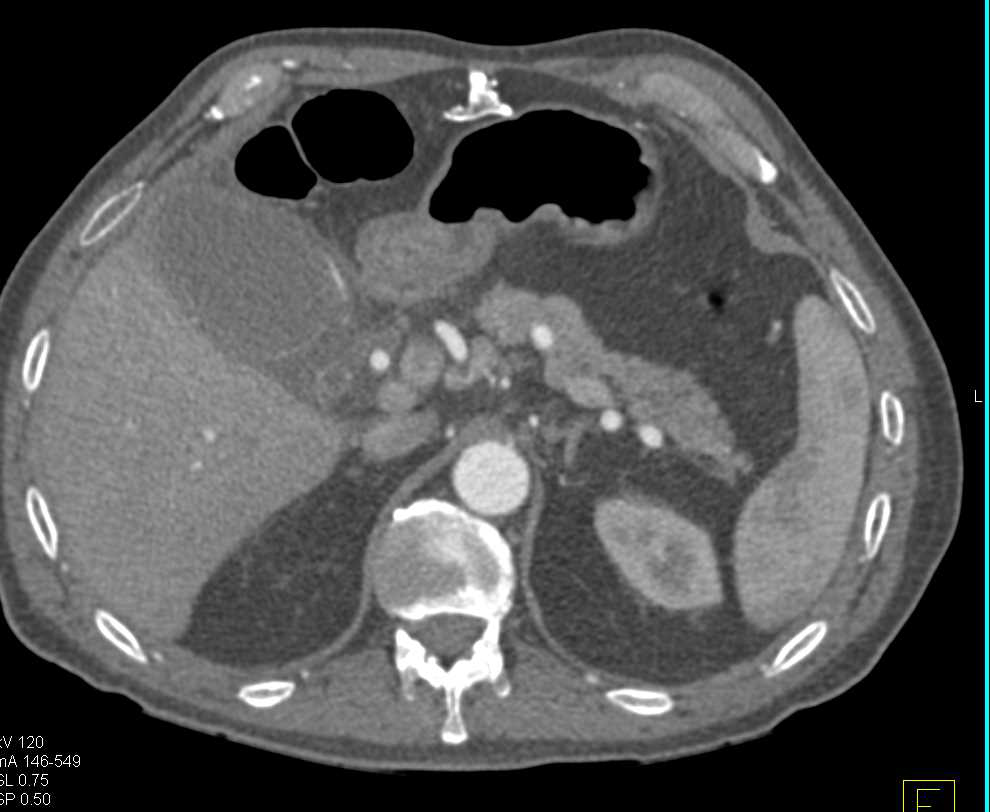 Acute Cholecystitis - CTisus CT Scan