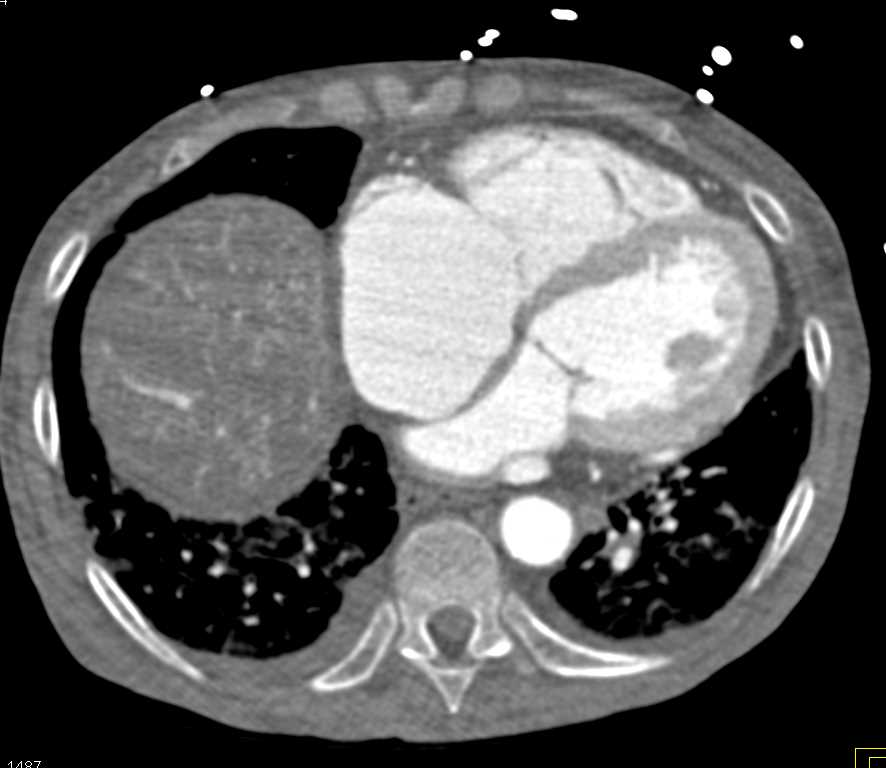 Multiple Arteriovenous Malformations (AVMs) in the Liver in Patient with Hereditary Hemorrhagic Telangiectasia (HHT) Disease - CTisus CT Scan