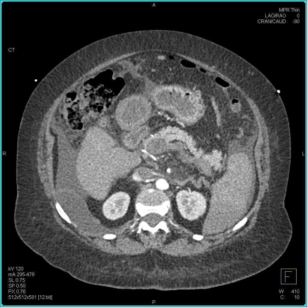 Cirrhosis with PV/Superior Mesenteric Vein (SMV) Occlusion - CTisus CT Scan