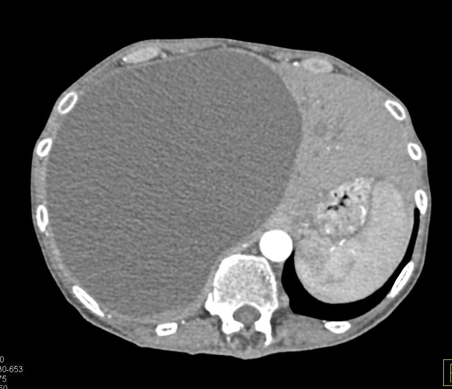 Large Simple Cyst of the Liver - CTisus CT Scan