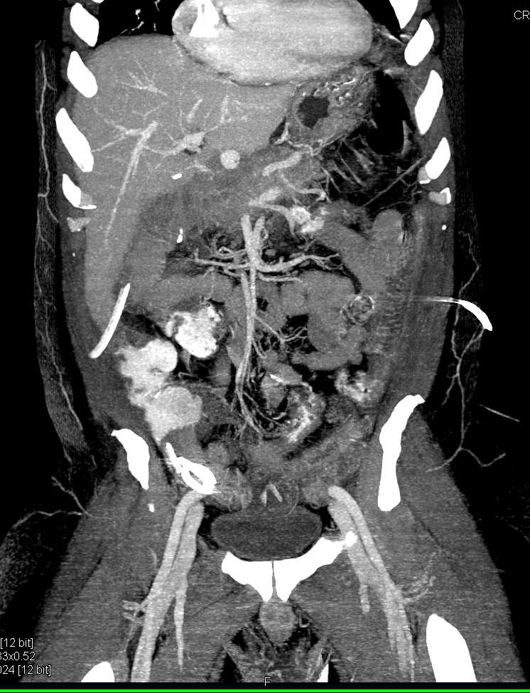 Multifocal Cholangiocarcinoma with Ascites - CTisus CT Scan