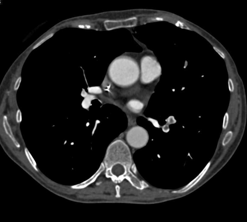 Incidental Pulmonary Emboli (PEs) in a Patient with Metastatic Disease to the Liver - CTisus CT Scan