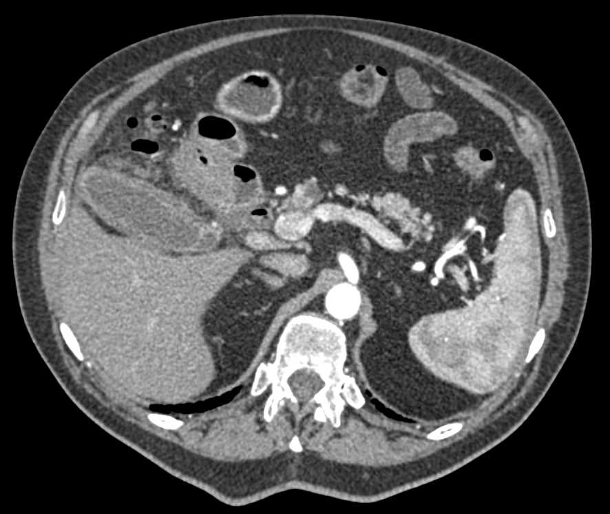 Invasive Gallbladder Cancer with Adenopathy - CTisus CT Scan