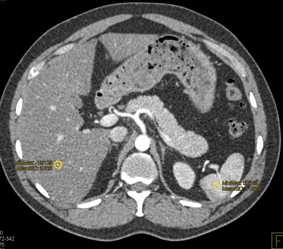 Fatty Liver - CTisus CT Scan
