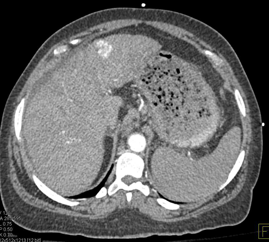Hepatocellular Carcinoma (Hepatoma) in a Cirrhotic Liver - CTisus CT Scan