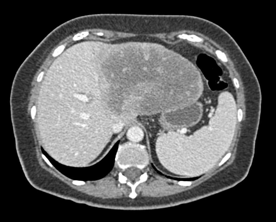 Cholangiocarcinoma with Adenopathy - CTisus CT Scan