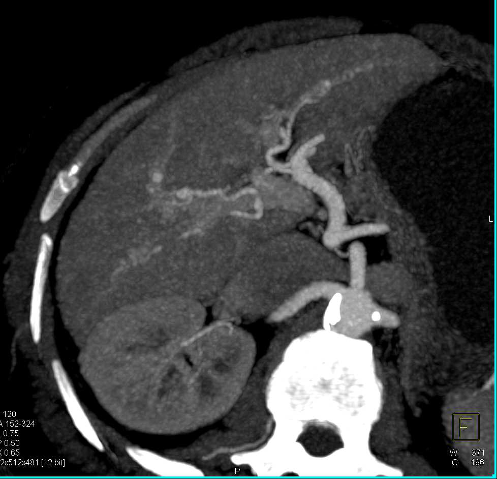 Cirrhosis with Large Varices and Portal Vein Thrombosis - CTisus CT Scan