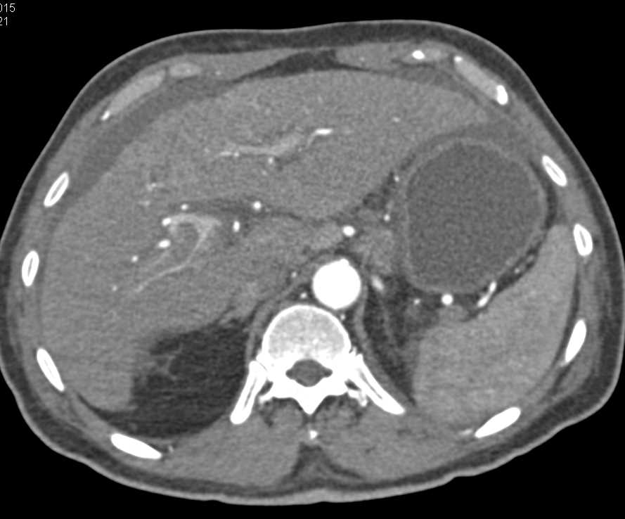 Hepatocellular Carcinoma (Hepatoma) Involves the Portal Vein - CTisus CT Scan