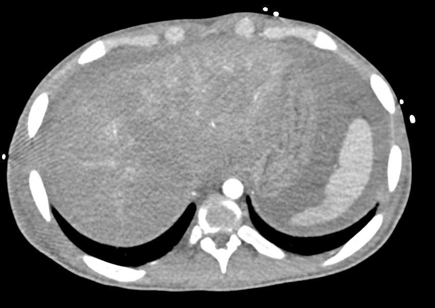 Sepsis RLQ with Poor Hepatic Perfusion - CTisus CT Scan
