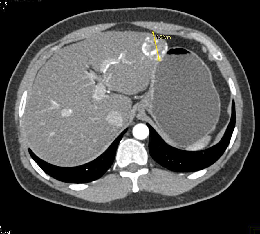 Hepatic Hemangioma - CTisus CT Scan