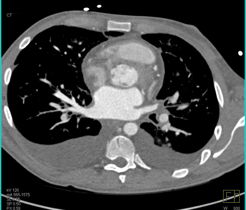 Cirrhosis with Portal Hypertension and Splenic Infarction - CTisus CT Scan