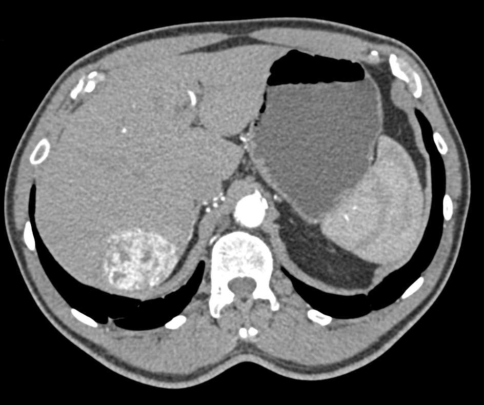 Hepatocellular Carcinoma (Hepatoma) with Neovascularity - CTisus CT Scan