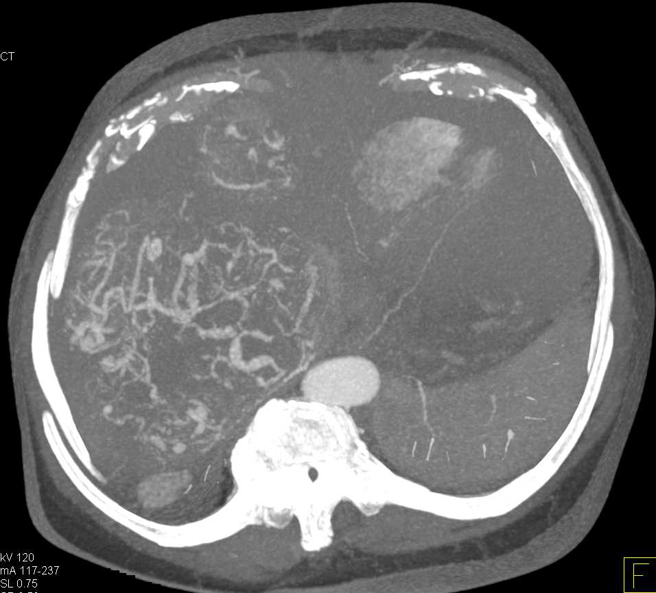 Multifocal Hepatocellular Carcinoma (Hepatoma) in Cirrhotic Liver - CTisus CT Scan