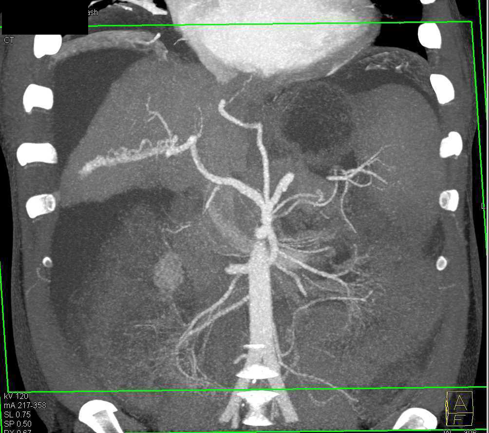 Arteriovenous (AV) Fistulae in Cirrhotic Liver - CTisus CT Scan