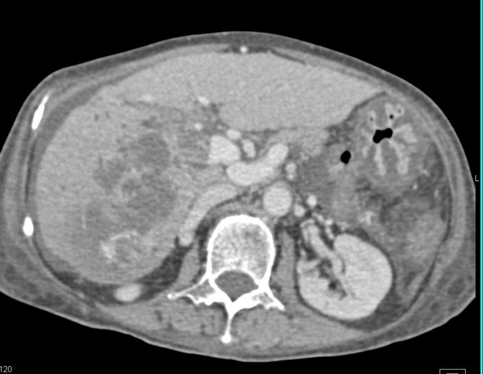 Liver Abscess in a Patient with Colitis - CTisus CT Scan