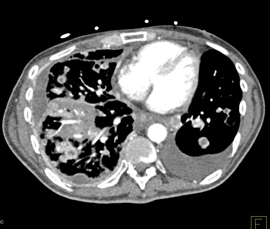 Metastatic Cholangiocarcinoma - CTisus CT Scan
