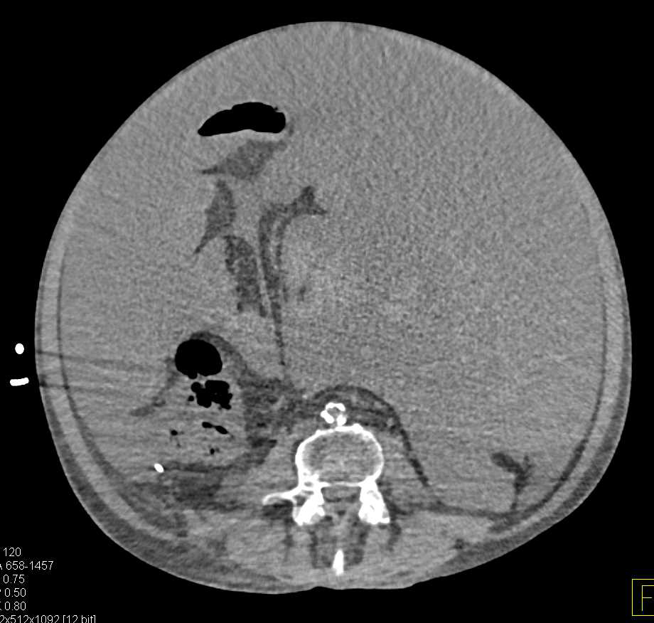 Cirrhosis with Massive Ascites - CTisus CT Scan
