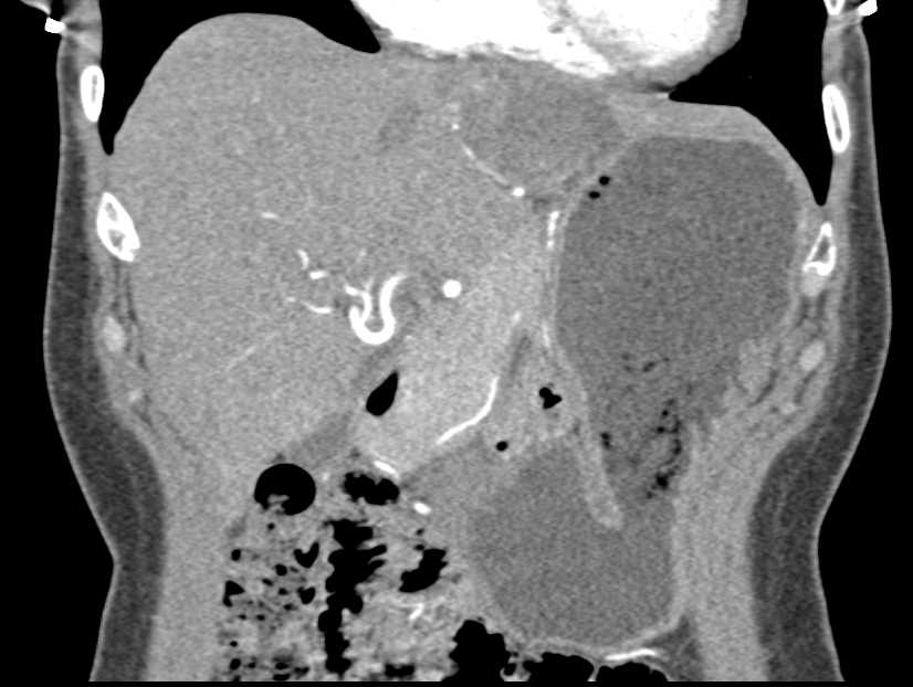 Hepatic Adenoma with Evidence of a Prior Bleed - CTisus CT Scan