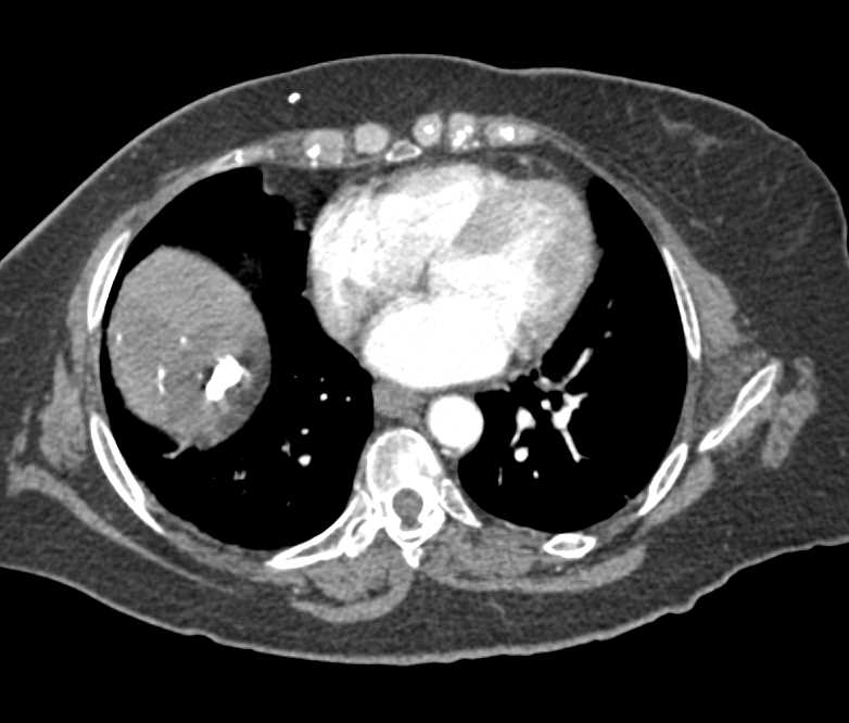 Sclerosed Hemangioma Liver - CTisus CT Scan