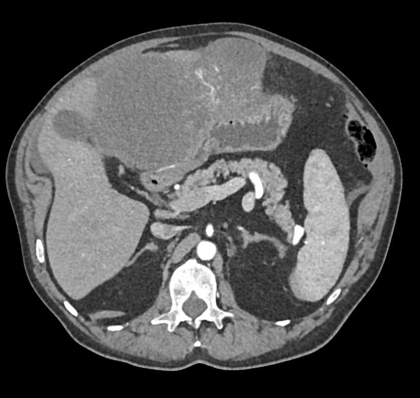 Biliary Cystadenocarcinoma - CTisus CT Scan