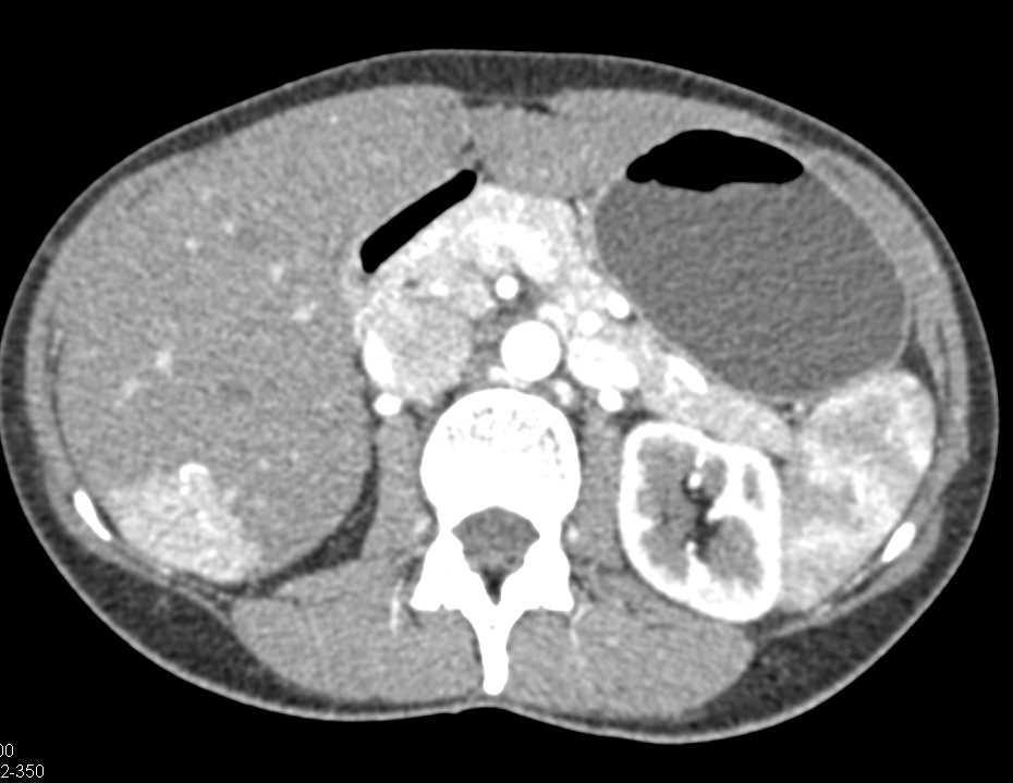 Focal Nodular Hyperplasia (FNH) Liver - CTisus CT Scan
