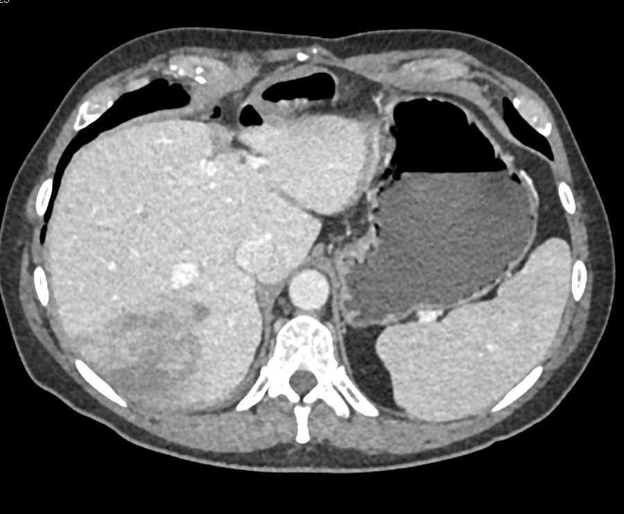 Liver Infarct Becomes an Abscess - CTisus CT Scan