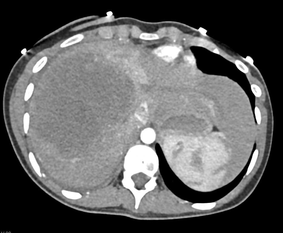 Necrotic Liver Abscess - CTisus CT Scan