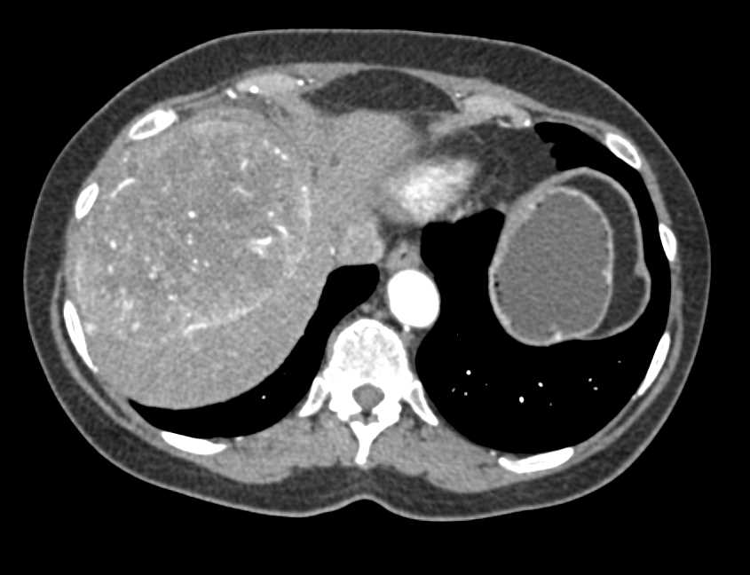 Hepatocellular Carcinoma (Hepatoma) with Pseudocapsule and Neovascularity - CTisus CT Scan