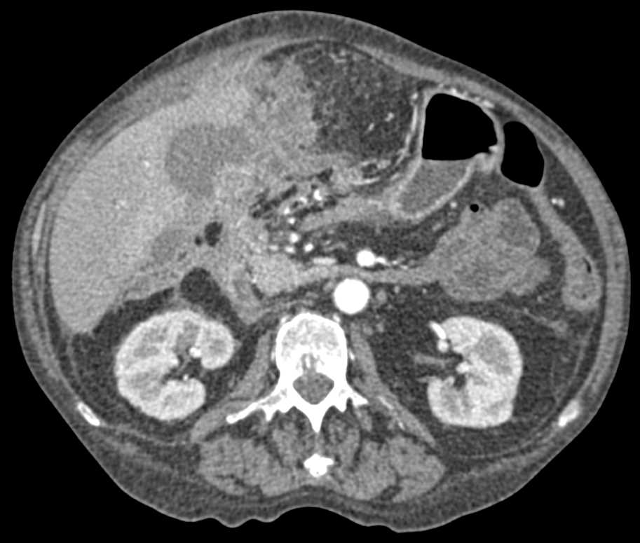 Gallbladder Cancer with Carcinomatosis - CTisus CT Scan