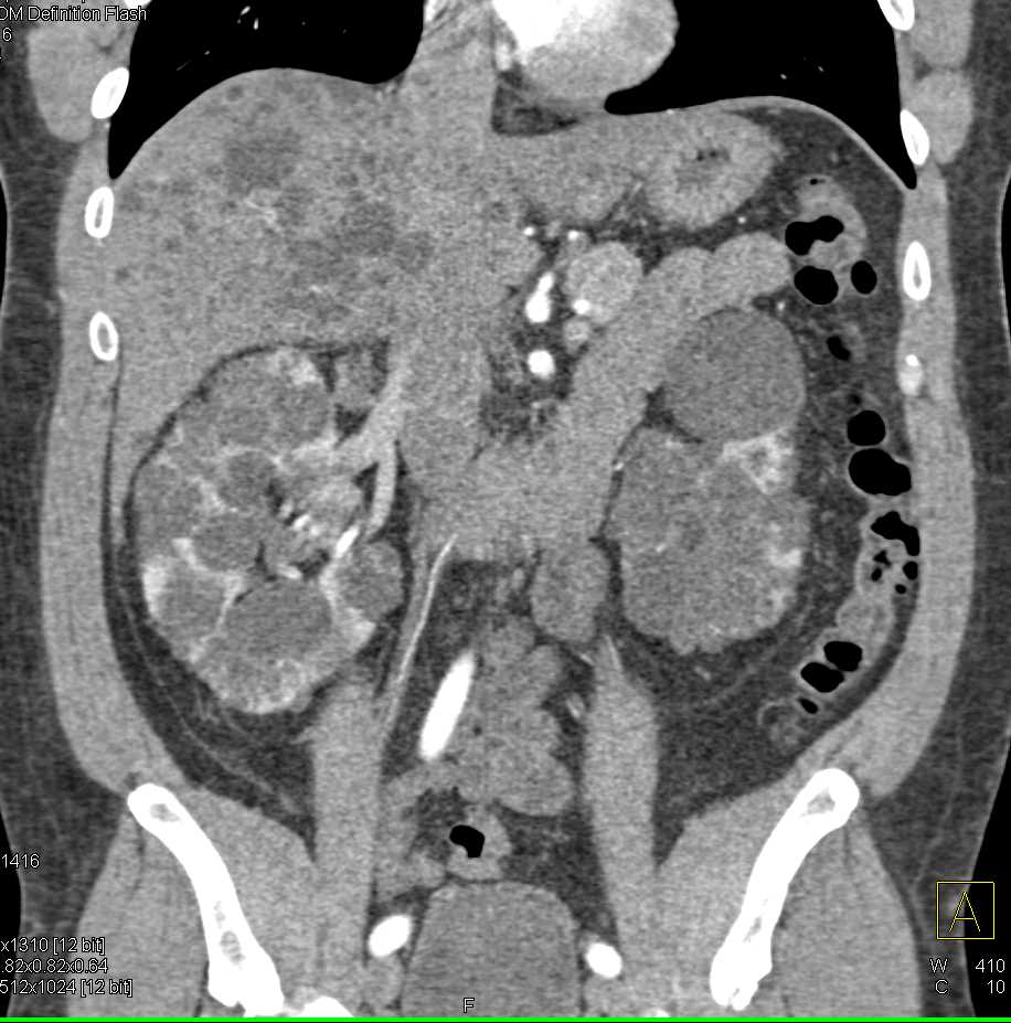Polycystic Liver and Kidney Disease - CTisus CT Scan