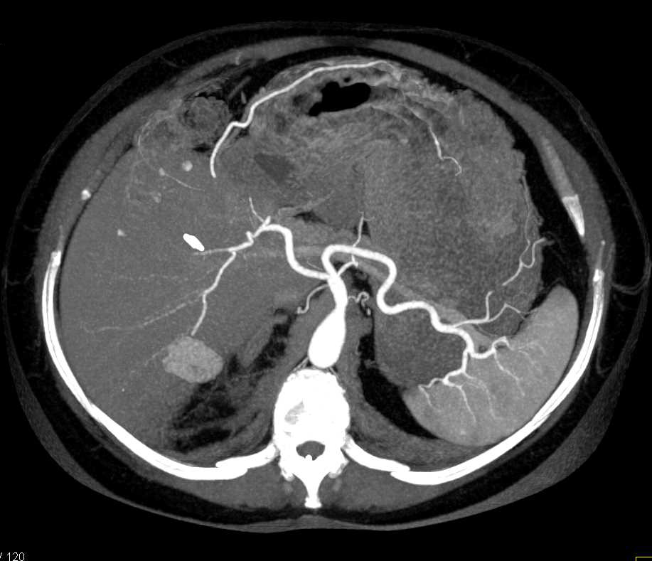Hepatic Infarction Post Liver Transplant - CTisus CT Scan