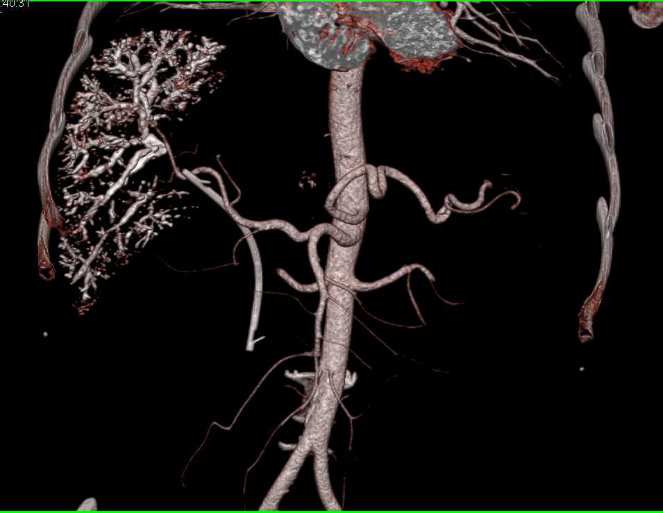 Embolization of Venous Map Liver - CTisus CT Scan