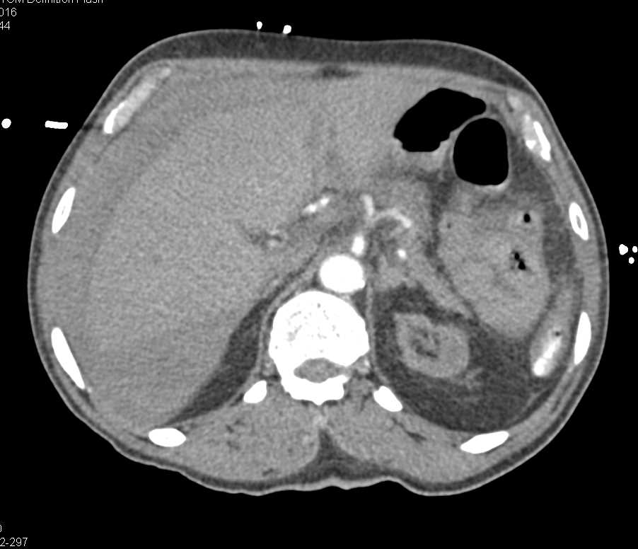Hemoperitoneum due to Hepatic Bleed, in a Patient with Hx of Renal Osteodystrophy - CTisus CT Scan