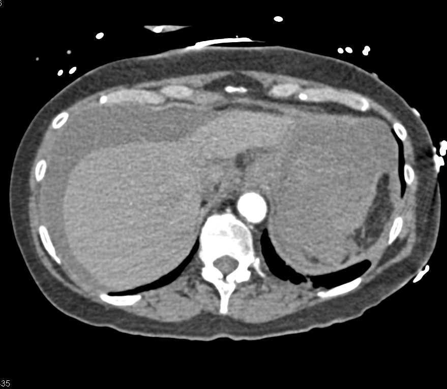 Splenic Rupture with Hemoperitoneum in Patient with Lung Cancer - CTisus CT Scan