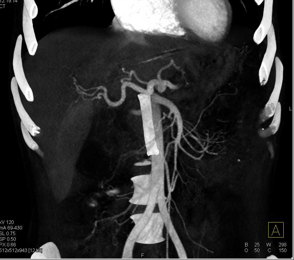 Acute Cholecystitis with Stent in Common Bile Duct (CBD) and Pancreatic Cancer - CTisus CT Scan