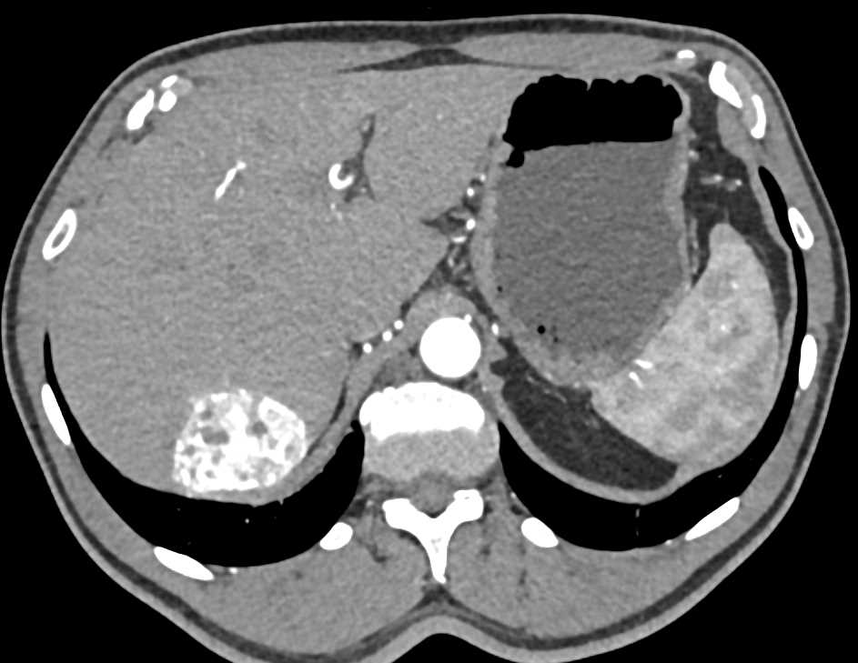 Atypical Hemangioma - CTisus CT Scan