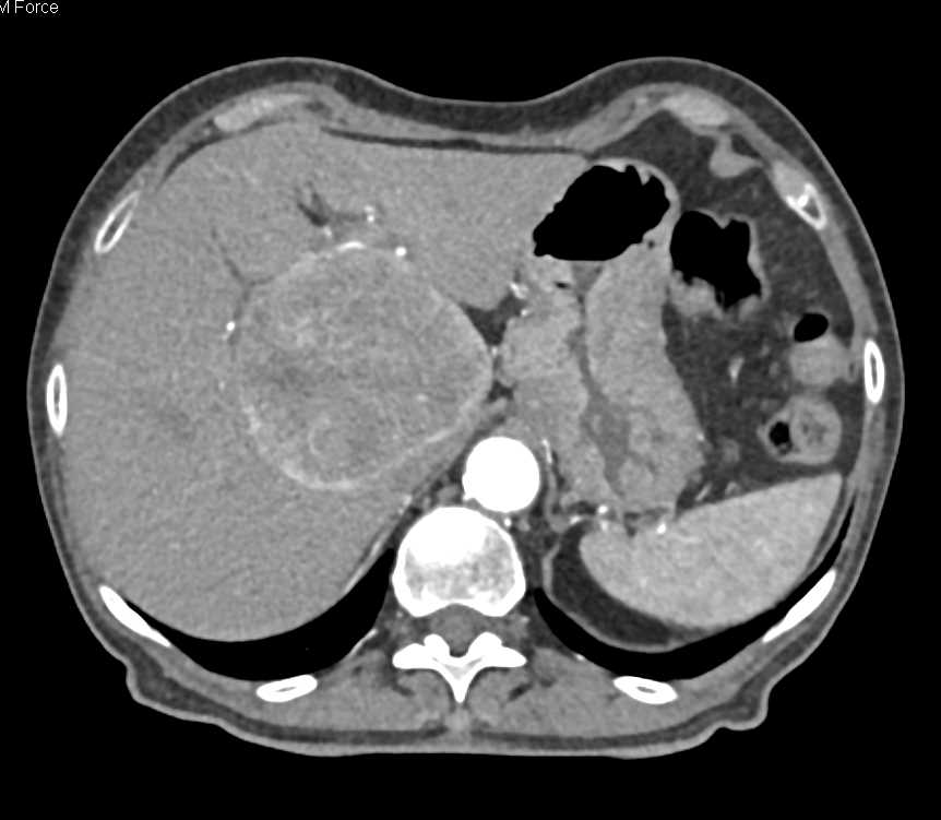Hepatocellular Carcinoma (Hepatoma) with Neovascularity - CTisus CT Scan