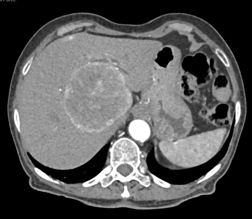 Hepatoma with Neovascularity - CTisus CT Scan