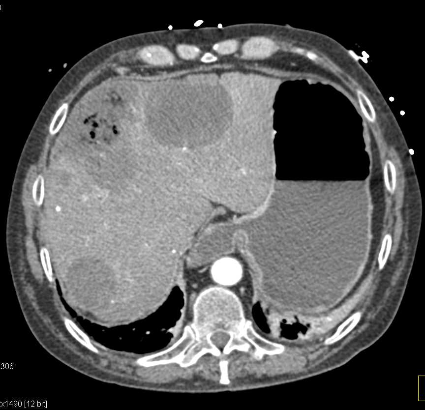 Liver Infarct with Abscess - CTisus CT Scan