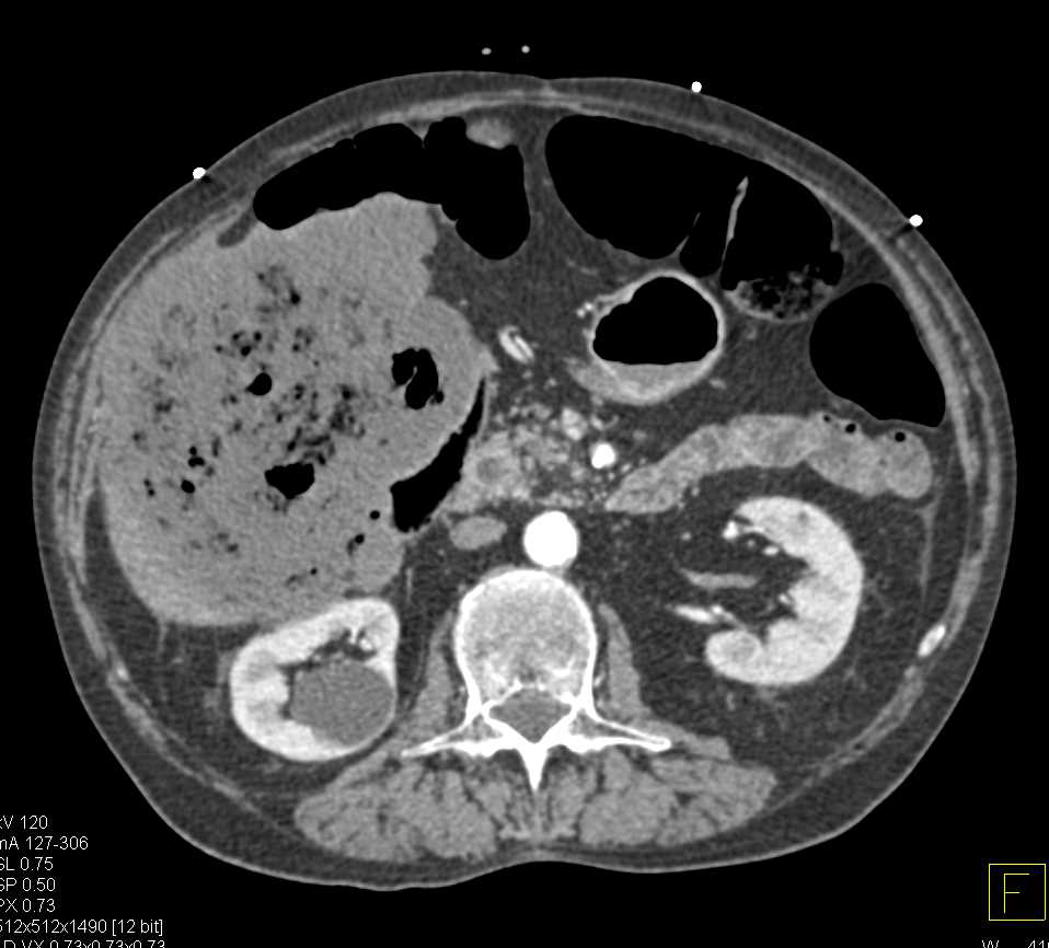 Hepatic Necrosis and Infarction - CTisus CT Scan