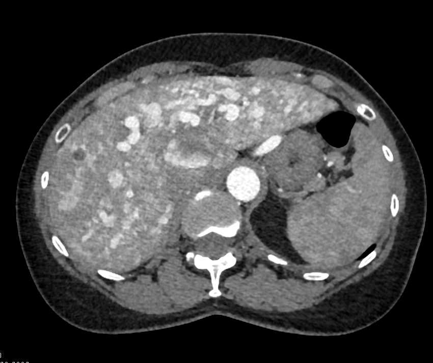 AV Shunting Liver in Hereditary Hemorrhagic Telangiectasia (HHT) Disease - CTisus CT Scan