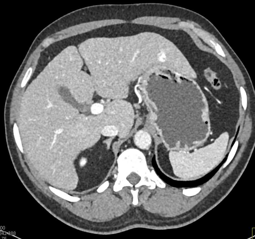 Cirrhosis with 1cm Hemangioma - CTisus CT Scan