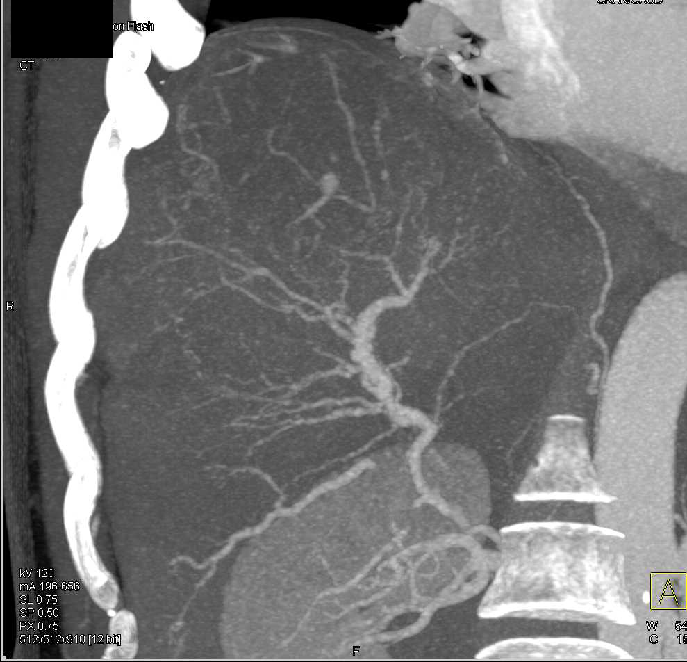 Cirrhosis with Vasculitis - CTisus CT Scan